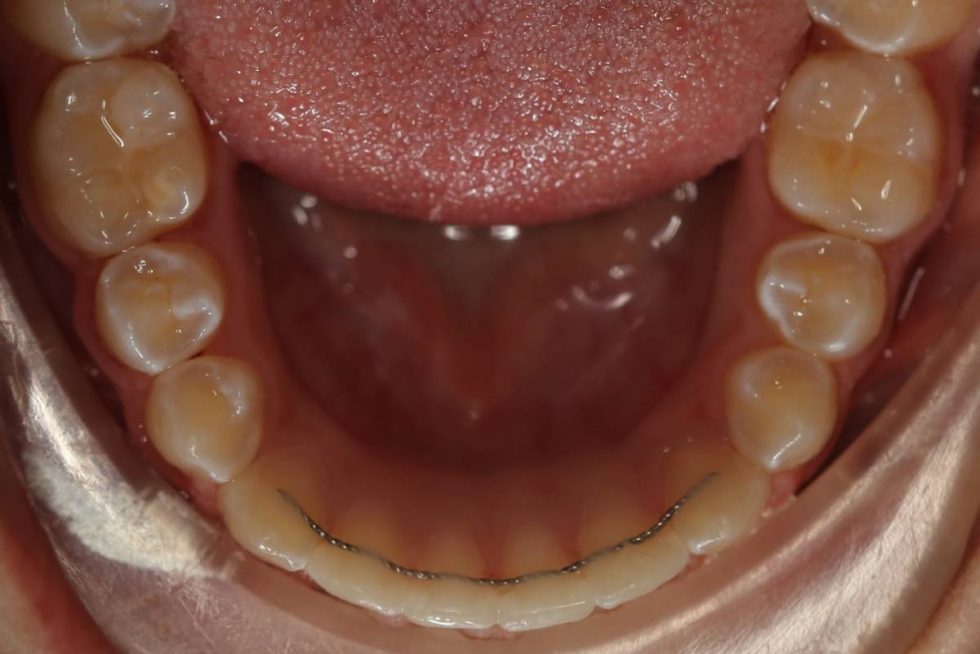 Earlwood Orthodontics Retention Earlwood Orthodontics